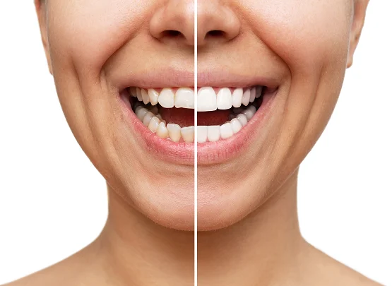 Hollywood Smile