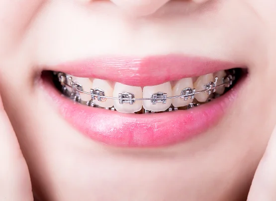 Braces